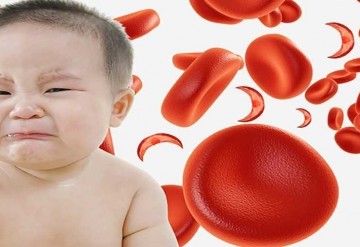 شیوع کم خونی در کودکانی که مستعد بیماری سلیاک هستند 