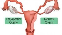 سلامت جنسی: اختلالات متابولیکی در بیماران مبتلا به سندرم تخمدان پلی کیستیک 