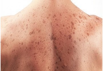 فرمی از ویتامین B می تواند سرطان پوست را کاهش دهد