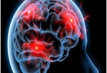 کارایی فولیک اسید در پیشگیری از سکته مغزی